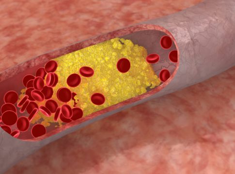 Como reducir el colesterol sin medicamentos
