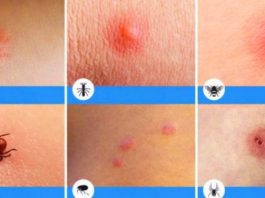 8 типов укусов насекомых, о которых вы просто обязаны знать