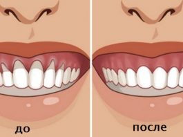 Вы заметили оголение шейки или корня зуба? Немедленно начинайте лечение — 6 натуральных рецептов