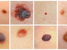 Узнайте, как распознать и предотвратить рак кожи