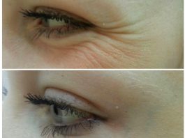 3 процедуры, которые помогут уменьшить «гусиные лапки» под глазами