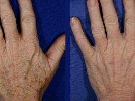 Омоложение кожи рук: 5 домашних рецептов для удаления морщин и пигментных пятен