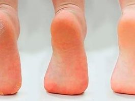 Применяйте 1 раз в неделю и ваши ноги станут здоровыми, а кожа стоп гладкой и шелковистой без трещин и натоптышей
