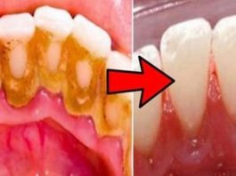 Вот как удалить зубной налет с зубов, не обращаясь к стоматологу
