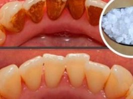 Зубной камень: вот, как вы можете удалить его самостоятельно, не посещая стоматолога