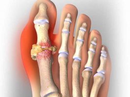 Болезни суставов, подагра артрит: три невероятно сильных рецепта лечения