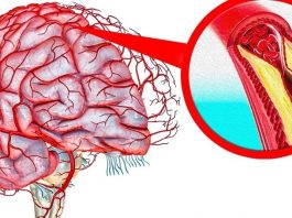 Быстрое и эффективное очищение сосудов головного мозга — 5 уникальных методик