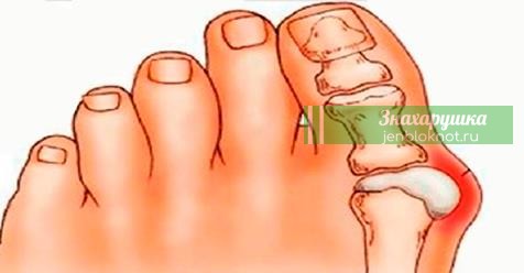 Картинки по запросу Косточки на ногах: эти 4 натуральных средства эффективно выведут соли и быстро избавят от боли