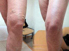 Потрясающая мазь для лечения узлов на ногах — тромбофлебита и варикоза